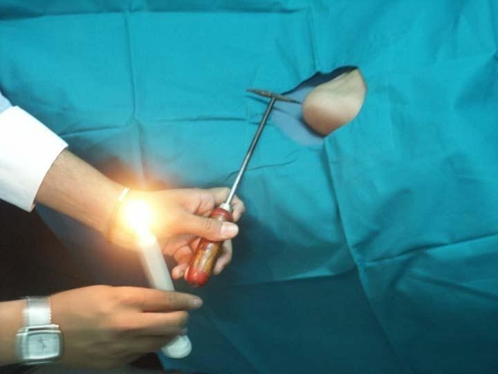 Agnikarma procedure
